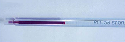 Капилляр малого объема (100 мкл), заполненный кровью